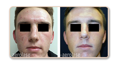 Before and after acne treatment comparison.
