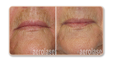 Before and after skin treatment comparison.