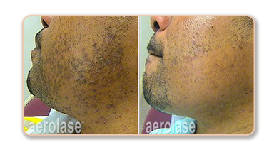 Before and after skin treatment comparison.