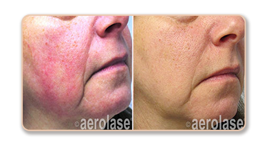 Before and after skin treatment results.